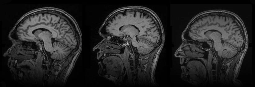 Whole Body MRI (Screening)
